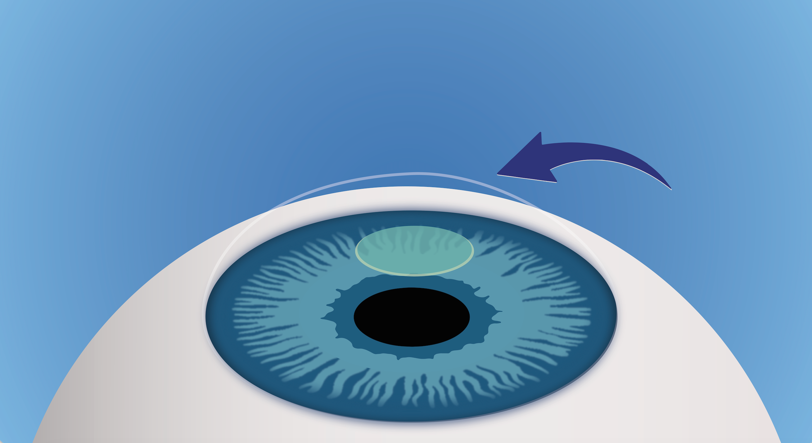 ALLOTEX TransForm™ Corneal lenticule | Mediconsult Österreich